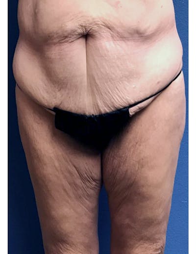 Thigh Lift Before & After Gallery - Patient 220268 - Image 1
