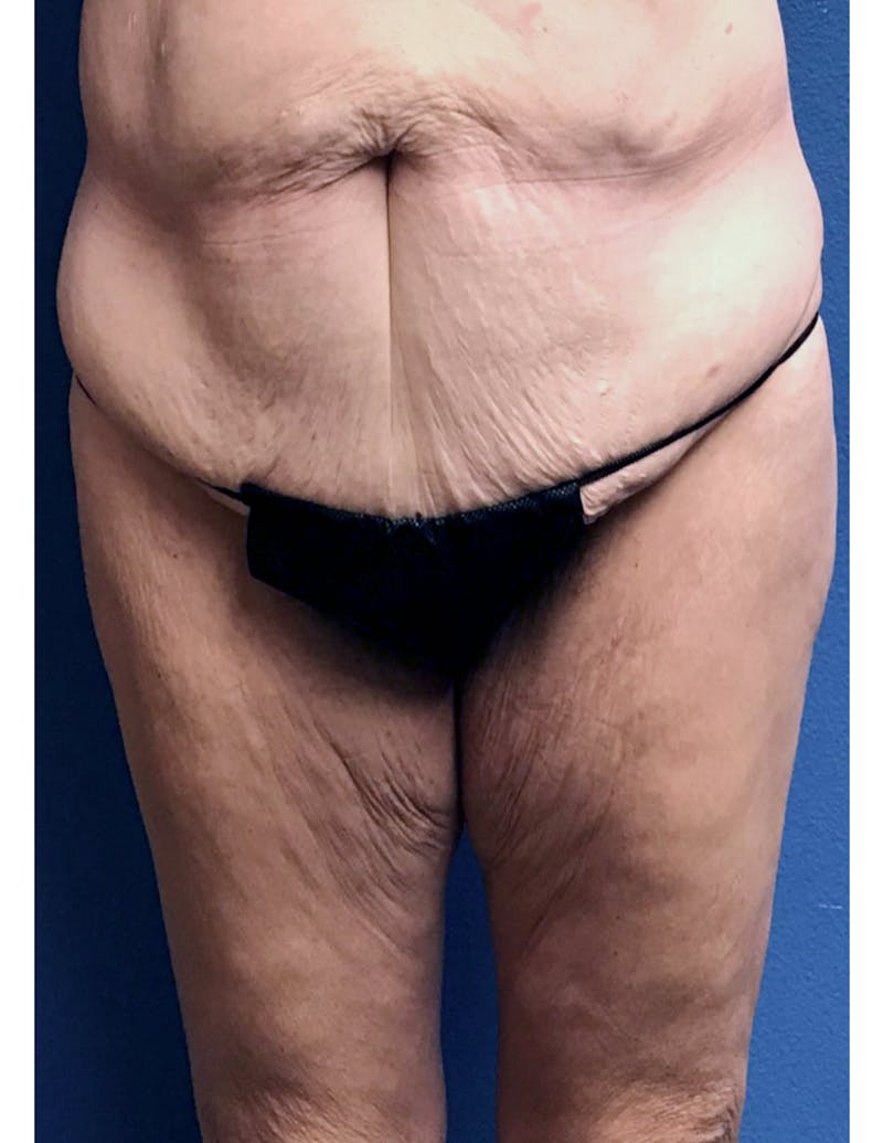 Thigh Lift Before & After Gallery - Patient 220268 - Image 1