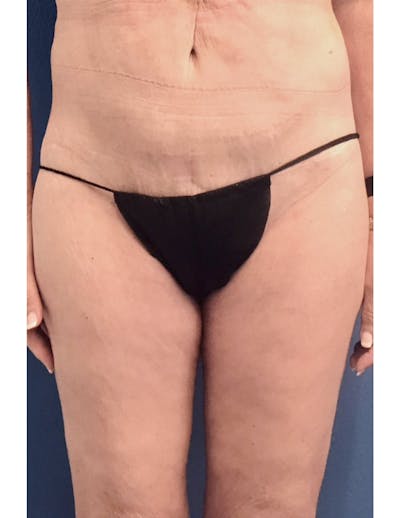 Thigh Lift Before & After Gallery - Patient 220268 - Image 2