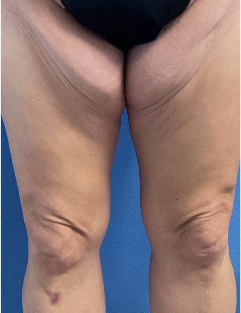 Thigh Lift Before & After Gallery - Patient 131059 - Image 1