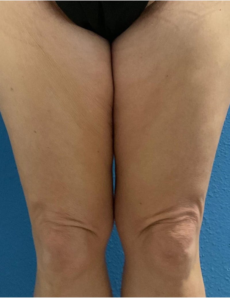 Thigh Lift Before & After Gallery - Patient 131059 - Image 2