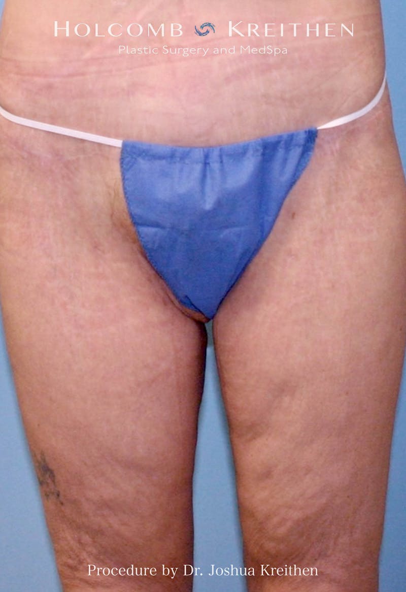Thigh Lift Before & After Gallery - Patient 884880 - Image 2