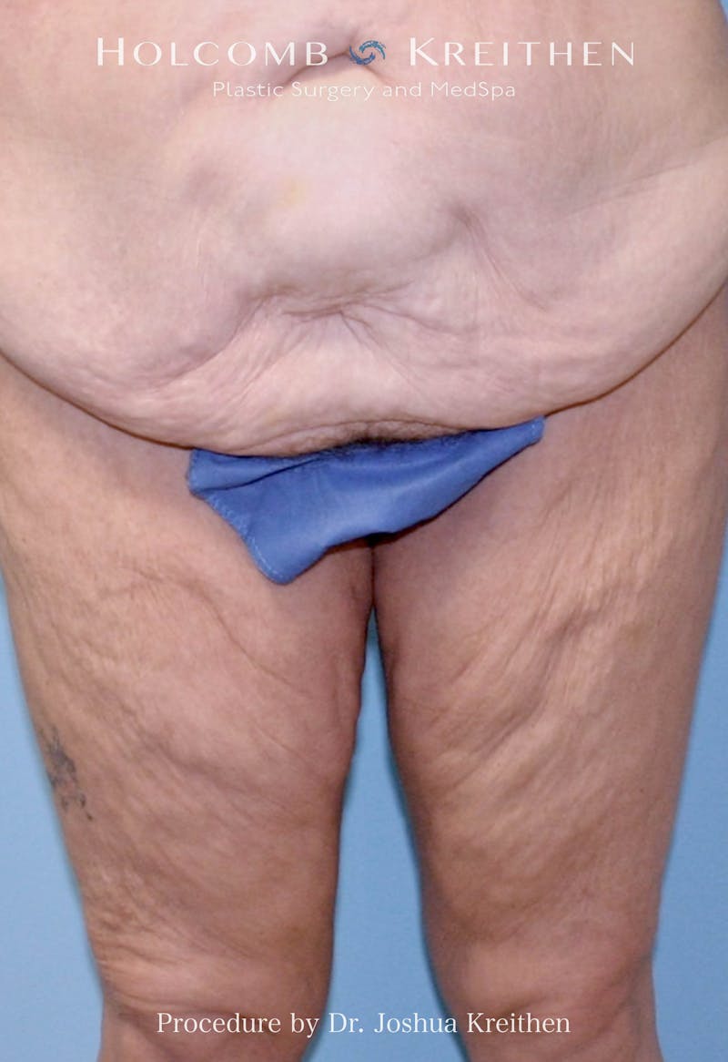 Thigh Lift Before & After Gallery - Patient 884880 - Image 1