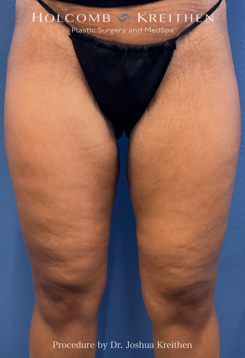 Thigh Lift Before & After Gallery - Patient 378342 - Image 2