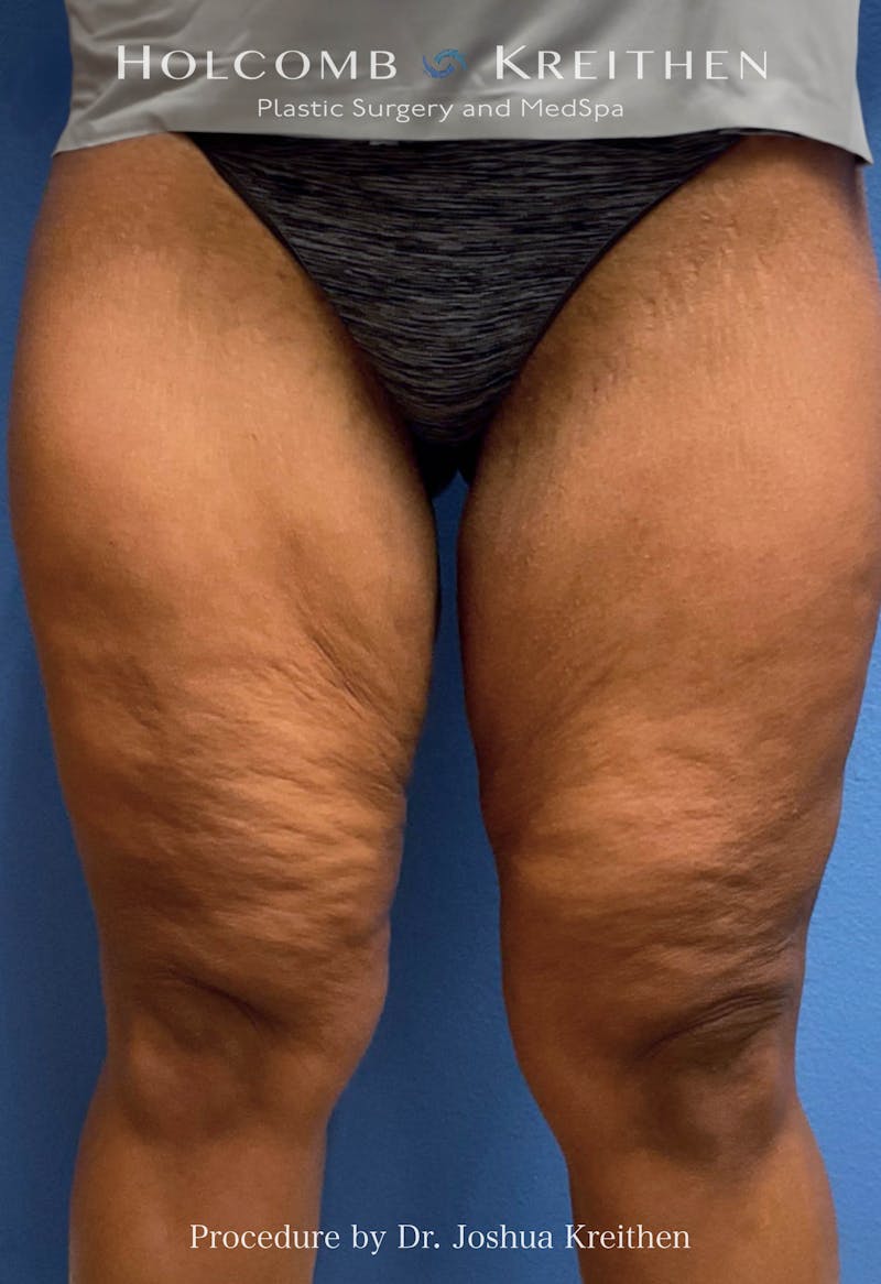 Thigh Lift Before & After Gallery - Patient 378342 - Image 1