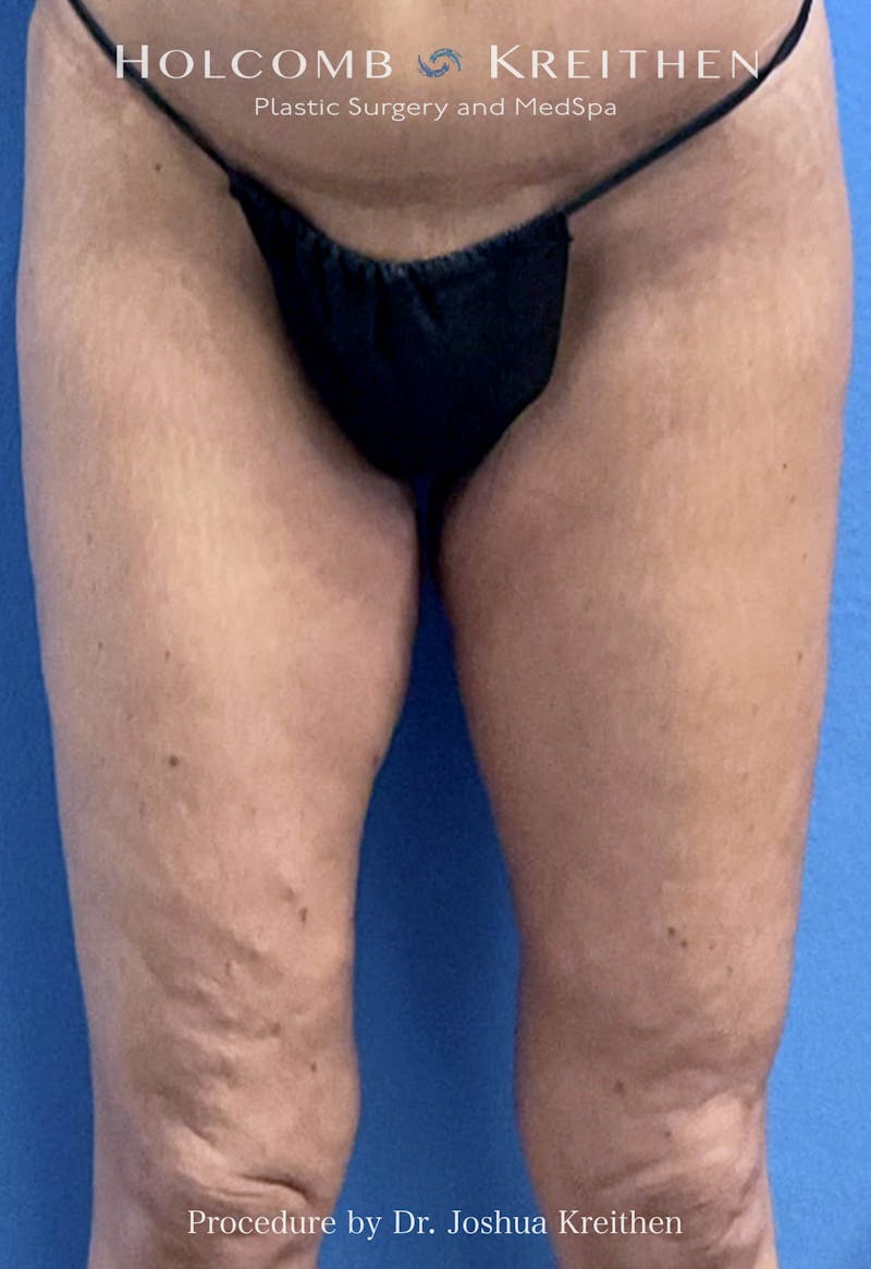 Thigh Lift Before & After Gallery - Patient 314919 - Image 2