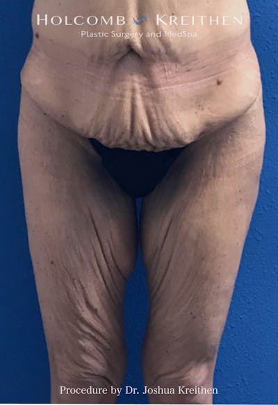 Thigh Lift Before & After Gallery - Patient 314919 - Image 1