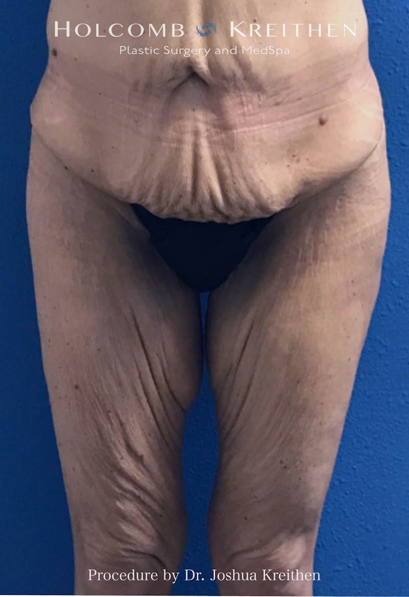Thigh Lift Before & After Gallery - Patient 314919 - Image 1