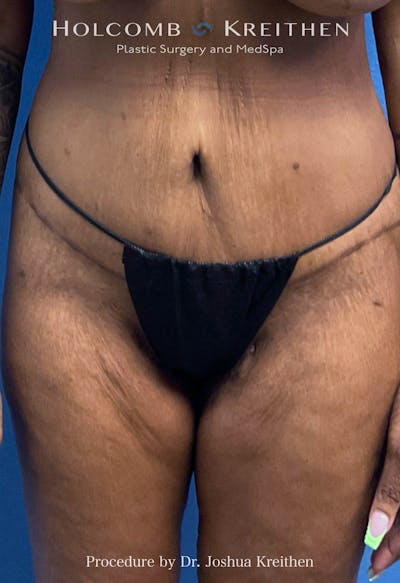 Thigh Lift Before & After Gallery - Patient 240999 - Image 2