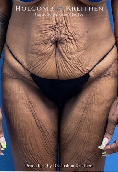 Thigh Lift Before & After Gallery - Patient 240999 - Image 1