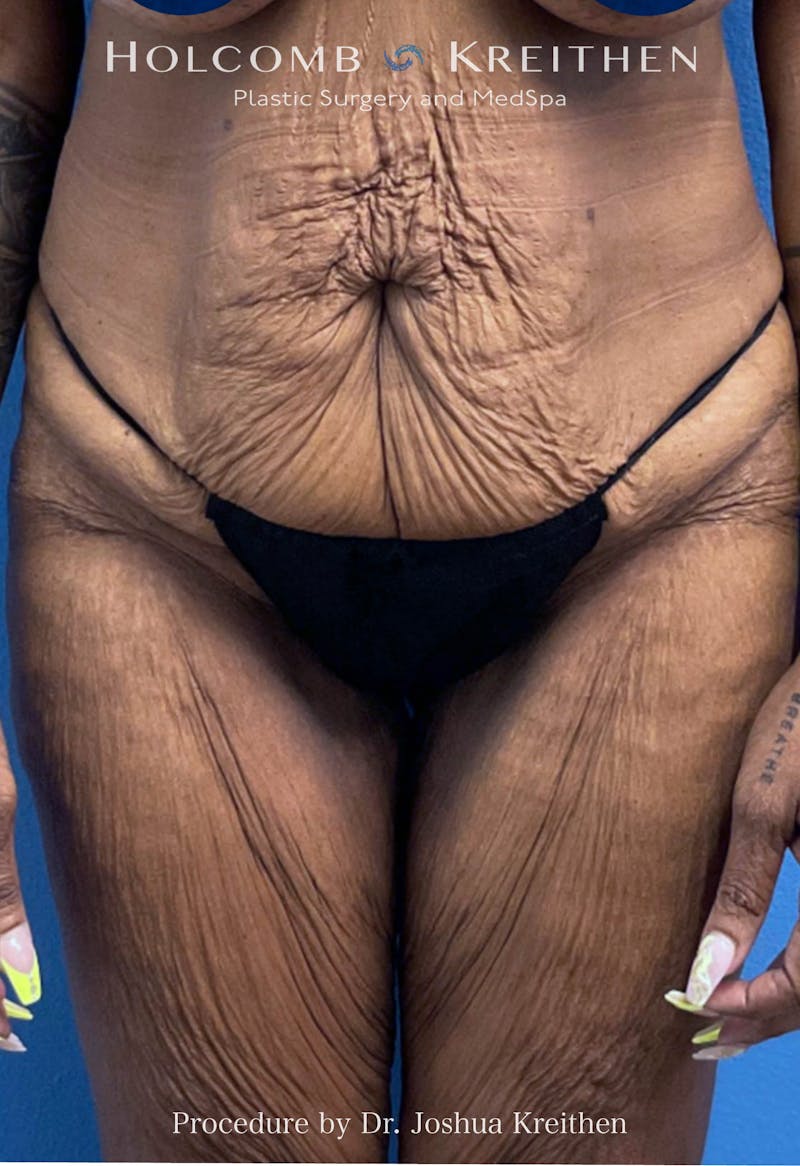 Thigh Lift Before & After Gallery - Patient 240999 - Image 1