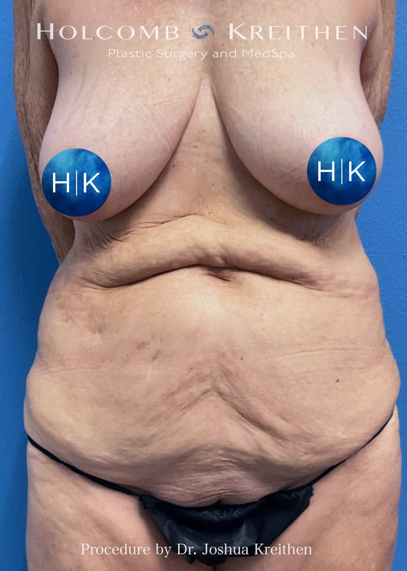 Tummy Tuck Before & After Gallery - Patient 275338 - Image 1