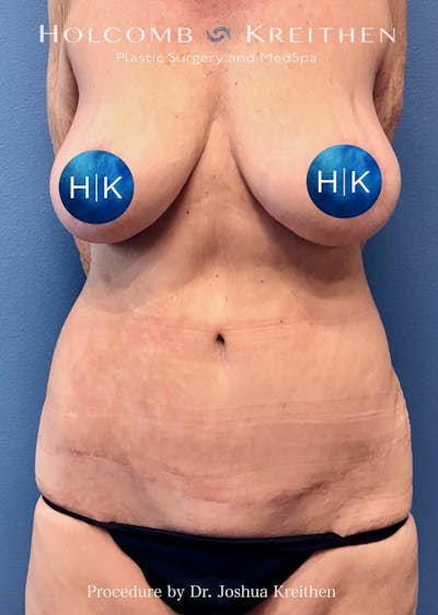 Tummy Tuck Before & After Gallery - Patient 275338 - Image 2