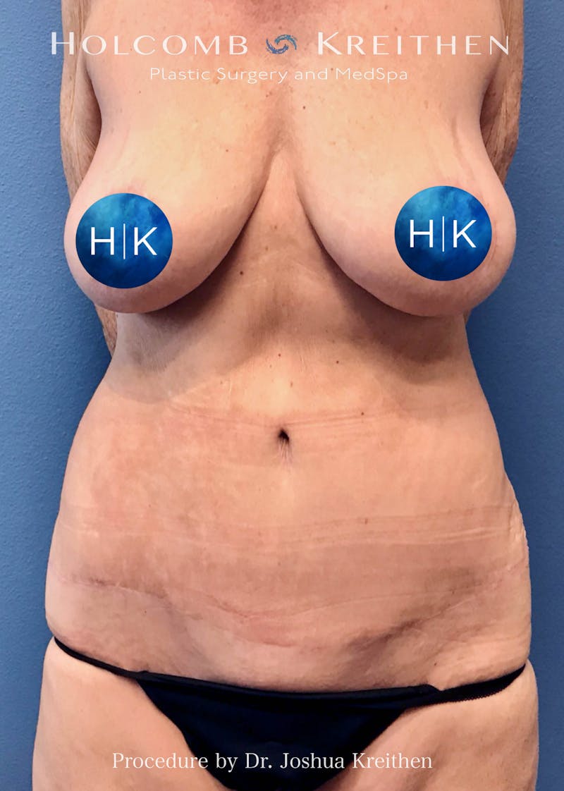 Tummy Tuck Before & After Gallery - Patient 275338 - Image 2