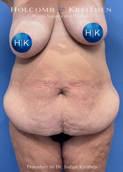 Tummy Tuck Before & After Gallery - Patient 440178 - Image 1