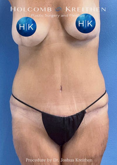 Tummy Tuck Before & After Gallery - Patient 440178 - Image 2