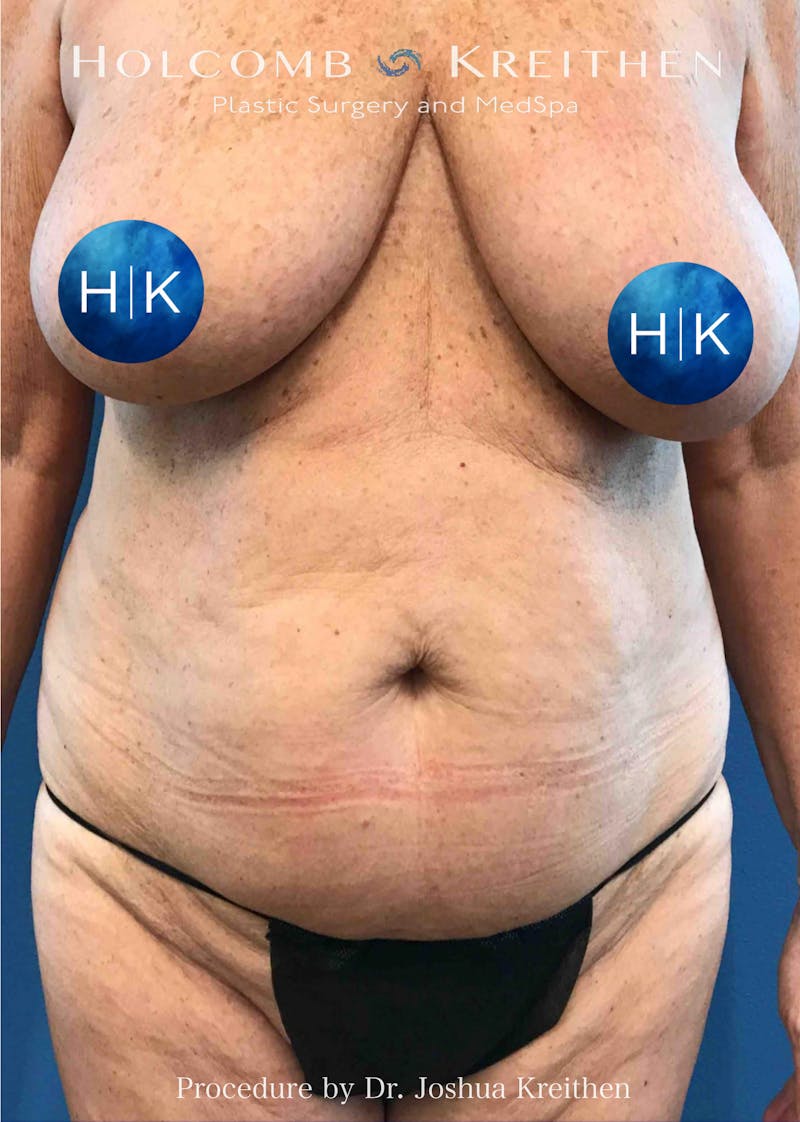 Tummy Tuck Before & After Gallery - Patient 129953 - Image 1