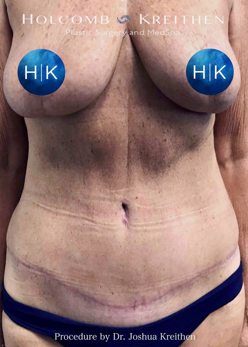 Tummy Tuck Before & After Gallery - Patient 129953 - Image 2