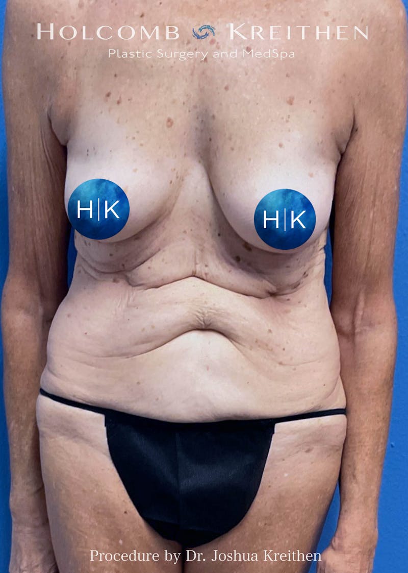 Tummy Tuck Before & After Gallery - Patient 392238 - Image 1