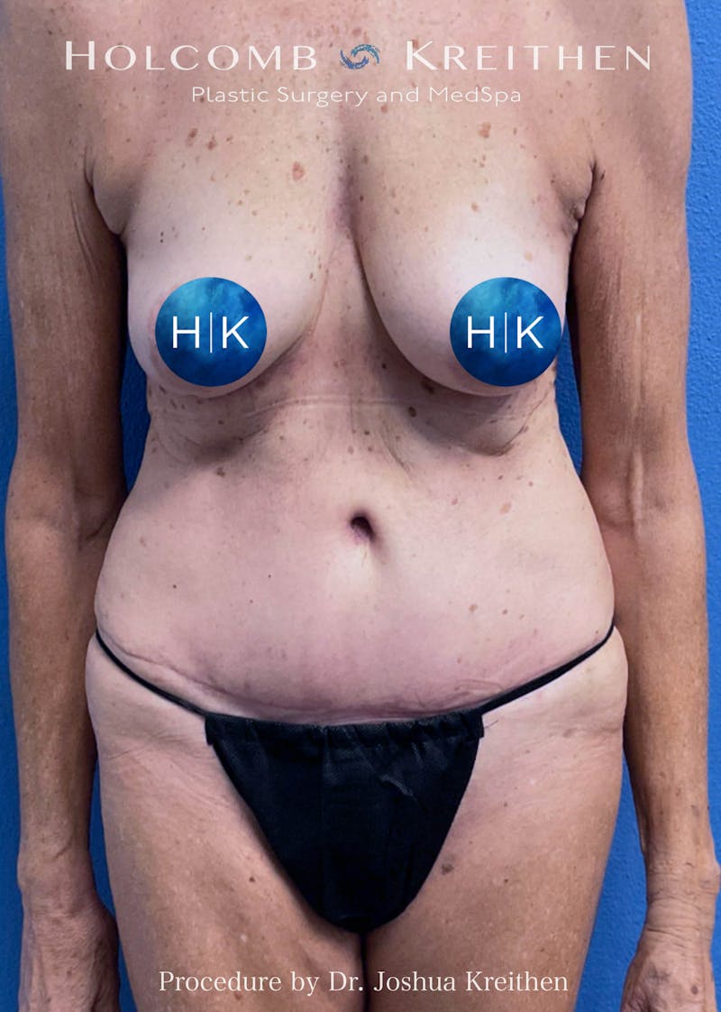 Tummy Tuck Before & After Gallery - Patient 392238 - Image 2
