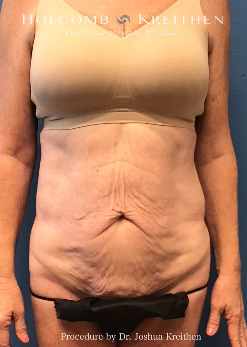 Tummy Tuck Before & After Gallery - Patient 198075 - Image 1