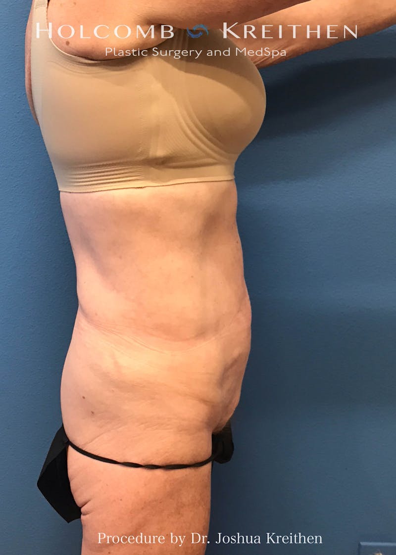 Tummy Tuck Before & After Gallery - Patient 198075 - Image 3