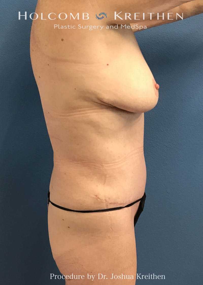 Tummy Tuck Before & After Gallery - Patient 198075 - Image 4