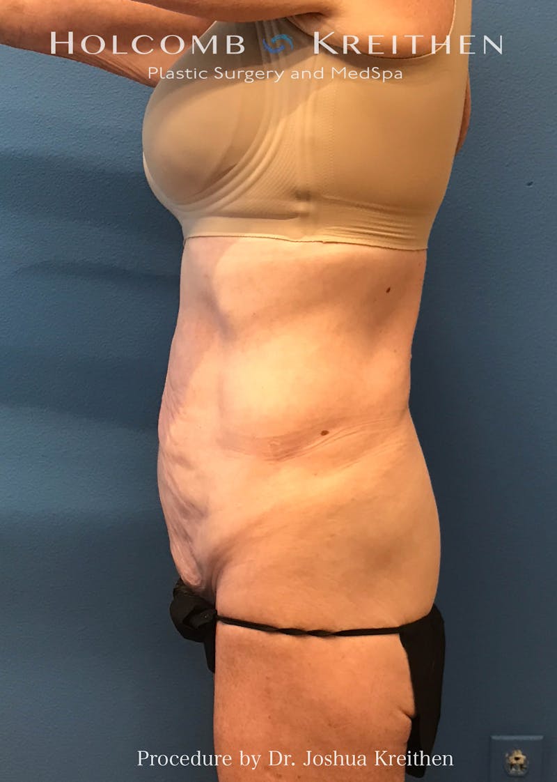 Tummy Tuck Before & After Gallery - Patient 198075 - Image 5