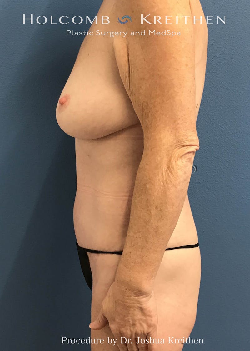 Tummy Tuck Before & After Gallery - Patient 198075 - Image 6