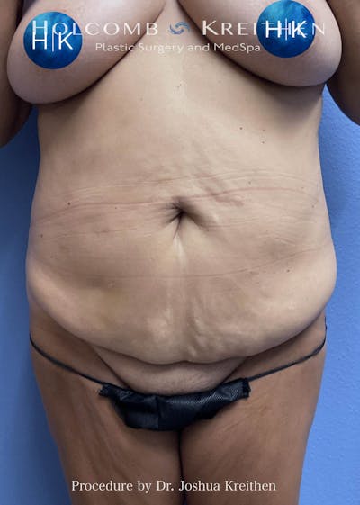 Tummy Tuck Before & After Gallery - Patient 303129 - Image 1