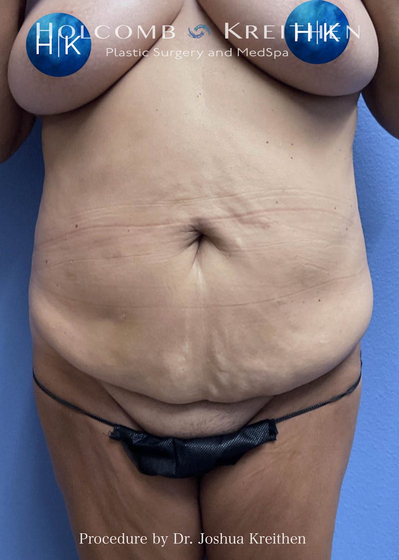 Tummy Tuck Before & After Gallery - Patient 303129 - Image 1