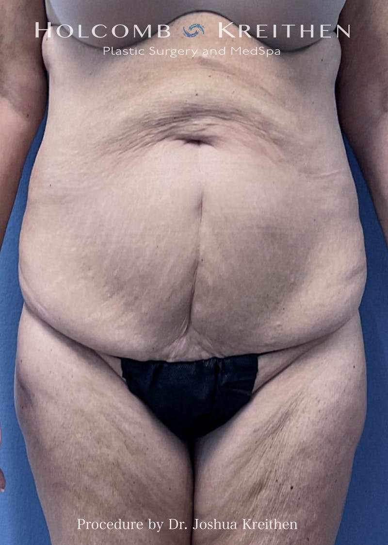 Tummy Tuck Before & After Gallery - Patient 826434 - Image 1