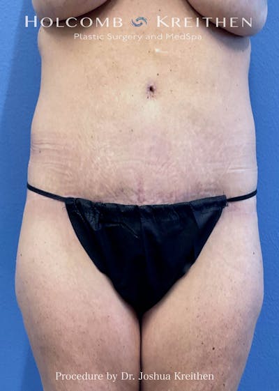 Tummy Tuck Before & After Gallery - Patient 826434 - Image 2