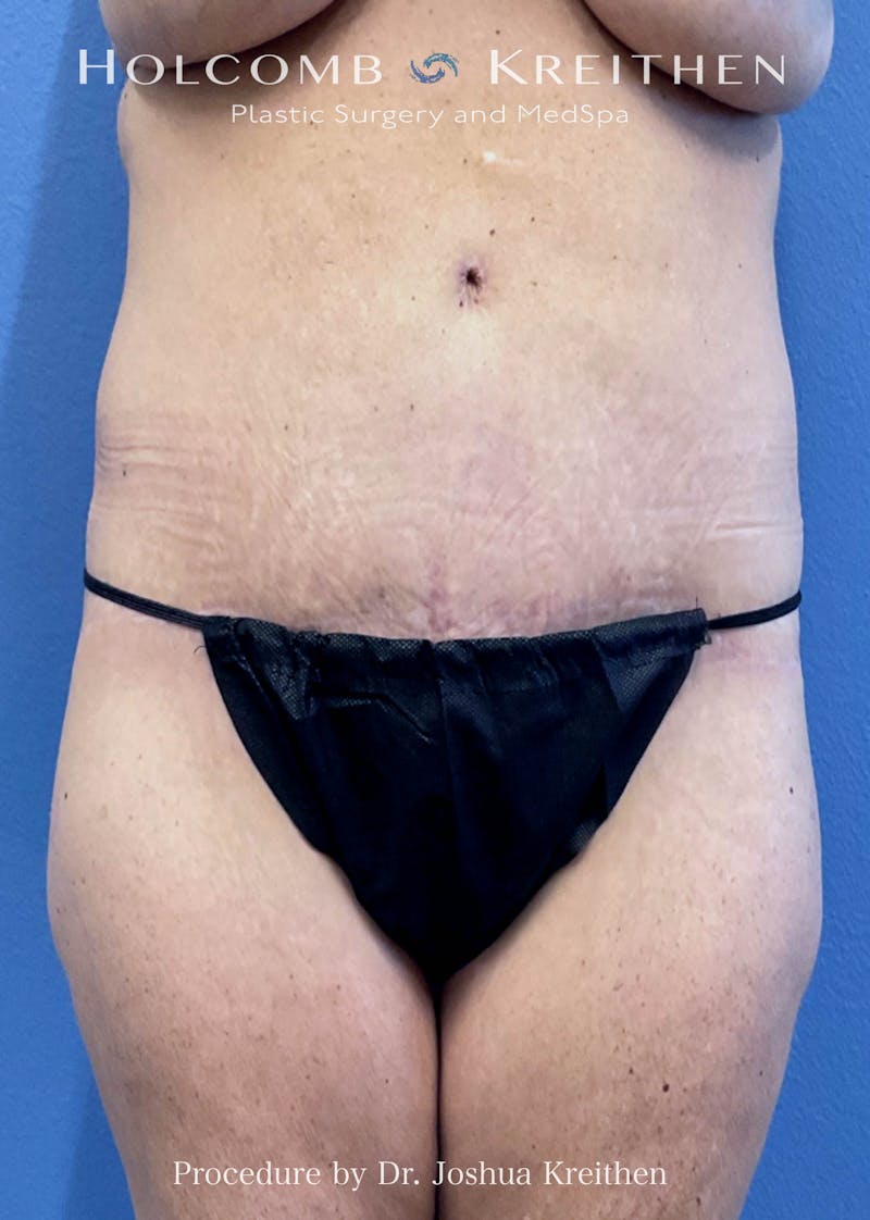 Tummy Tuck Before & After Gallery - Patient 826434 - Image 2