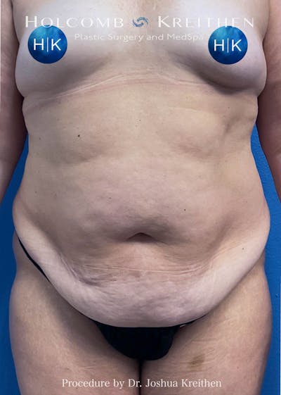 Tummy Tuck Before & After Gallery - Patient 357528 - Image 1