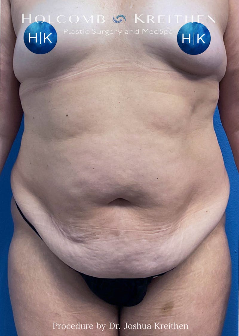 Tummy Tuck Before & After Gallery - Patient 357528 - Image 1