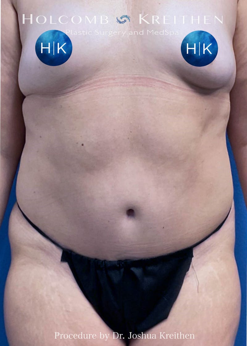 Tummy Tuck Before & After Gallery - Patient 357528 - Image 2