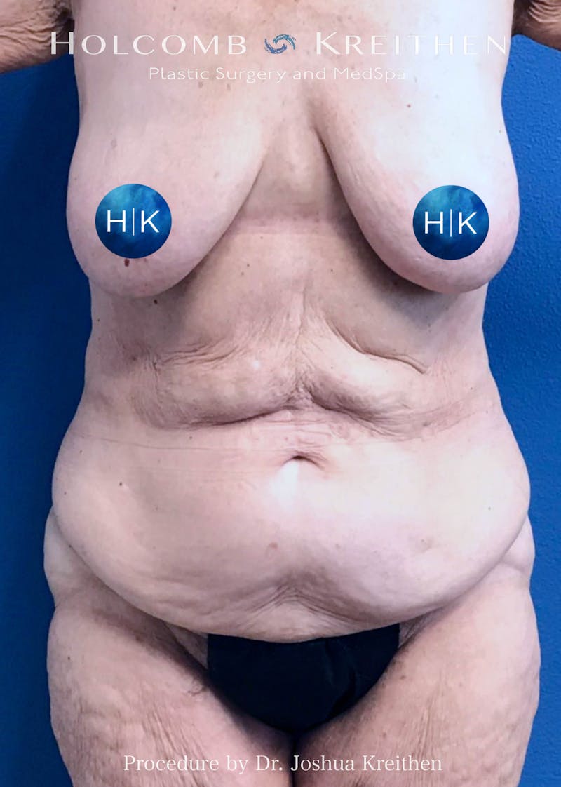 Tummy Tuck Before & After Gallery - Patient 404015 - Image 1