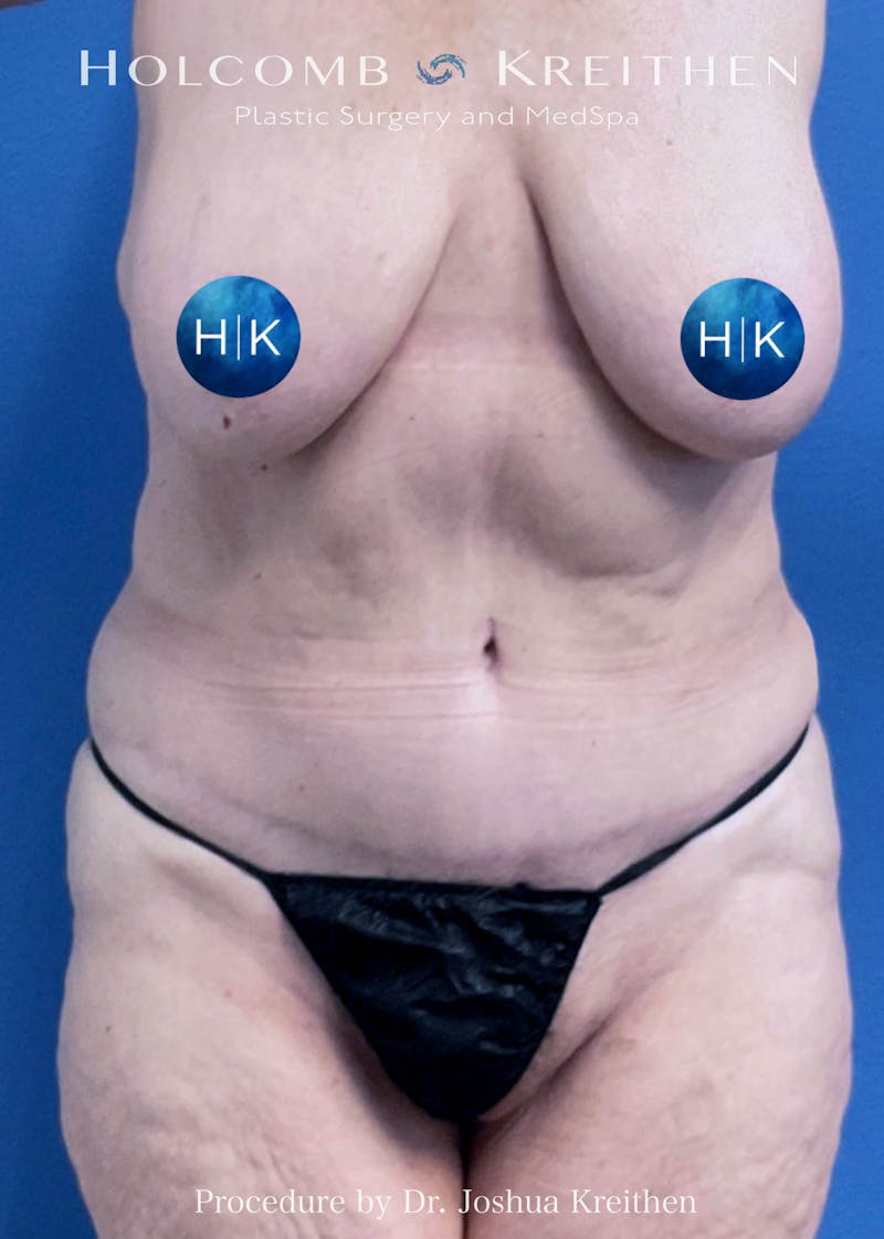 Tummy Tuck Before & After Gallery - Patient 404015 - Image 2