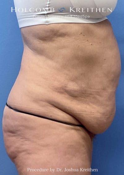 Tummy Tuck Before & After Gallery - Patient 359153 - Image 1
