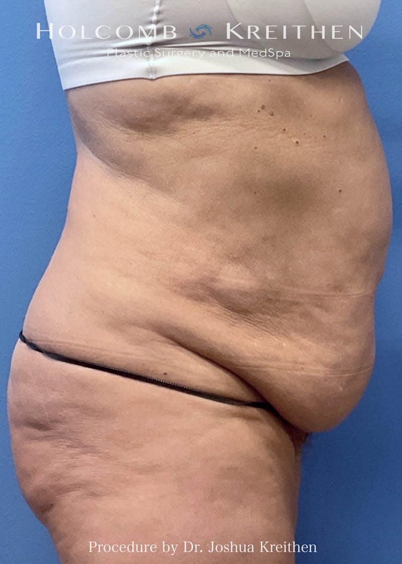 Tummy Tuck Before & After Gallery - Patient 359153 - Image 1