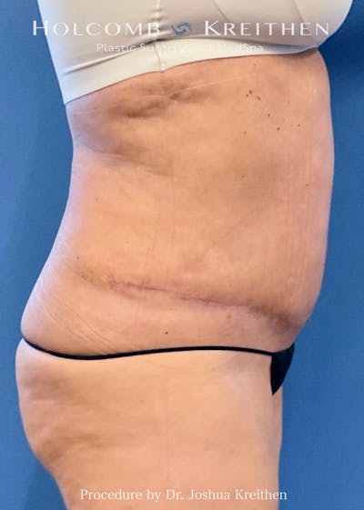 Tummy Tuck Before & After Gallery - Patient 359153 - Image 2