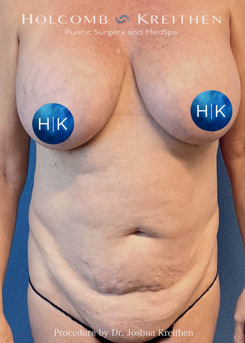 Tummy Tuck Before & After Gallery - Patient 305102 - Image 1