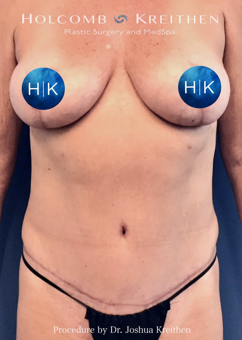 Tummy Tuck Before & After Gallery - Patient 305102 - Image 2