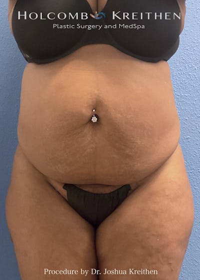 Tummy Tuck Before & After Gallery - Patient 376920 - Image 1