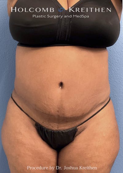 Tummy Tuck Before & After Gallery - Patient 376920 - Image 2