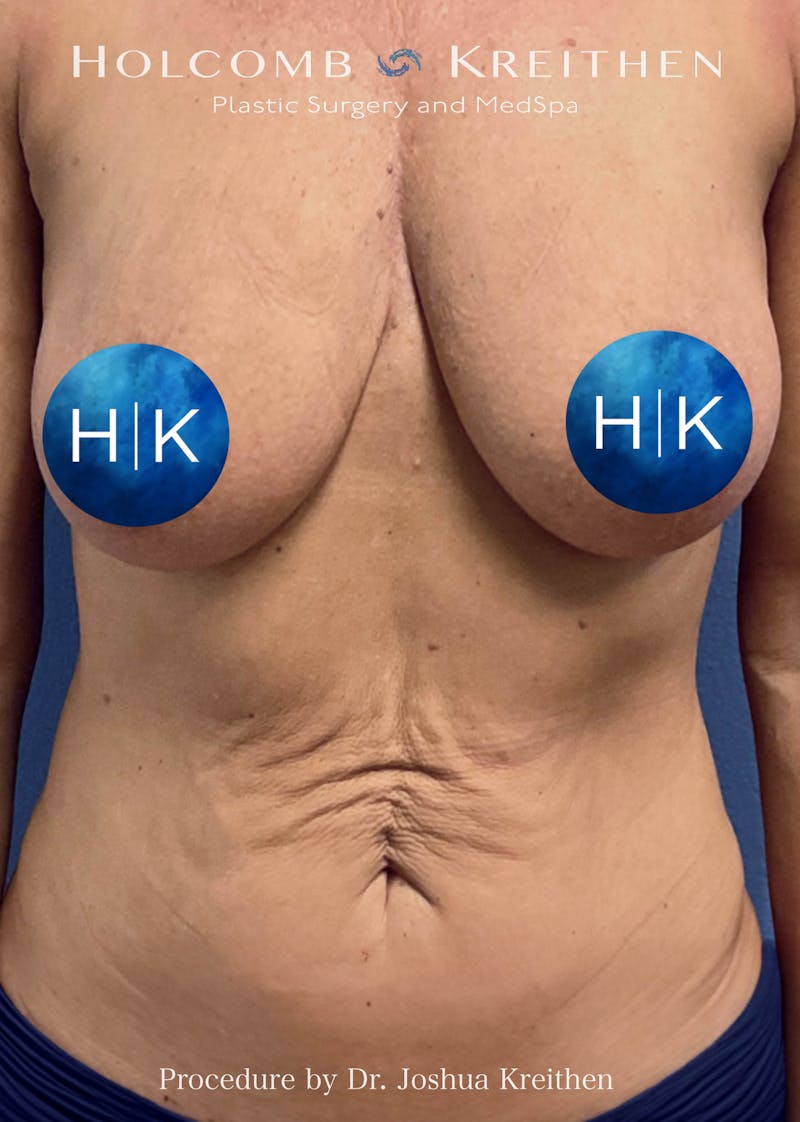 Tummy Tuck Before & After Gallery - Patient 257686 - Image 1