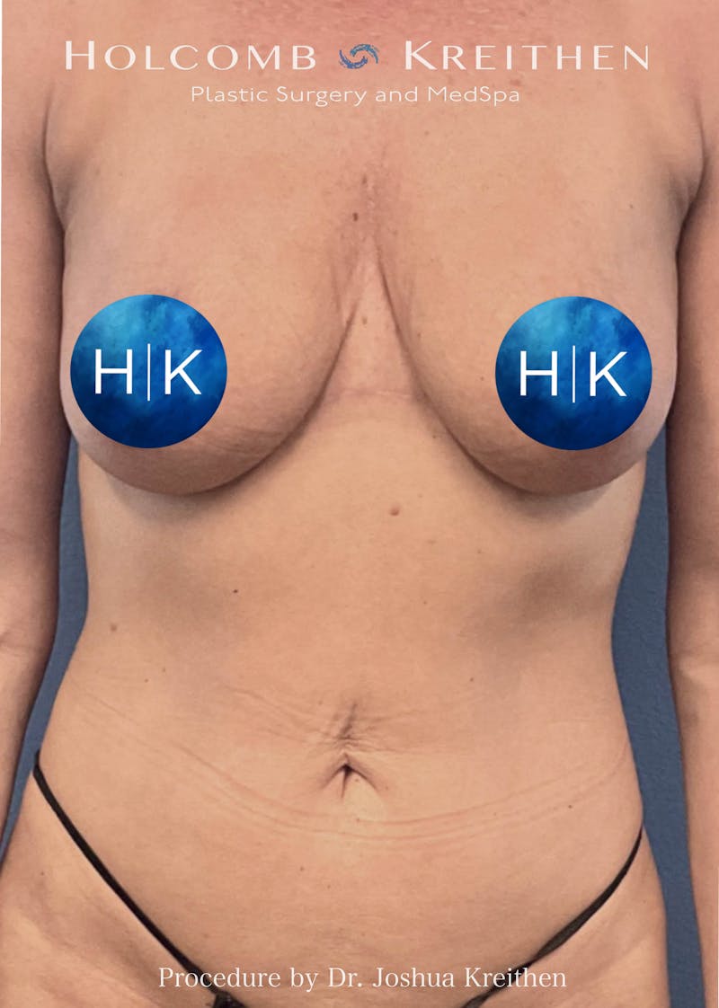 Tummy Tuck Before & After Gallery - Patient 257686 - Image 2