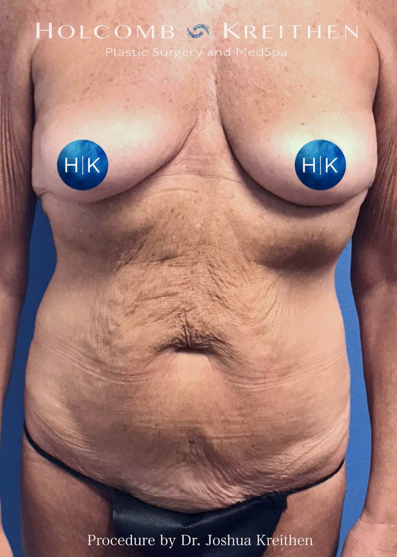 Tummy Tuck Before & After Gallery - Patient 282582 - Image 1