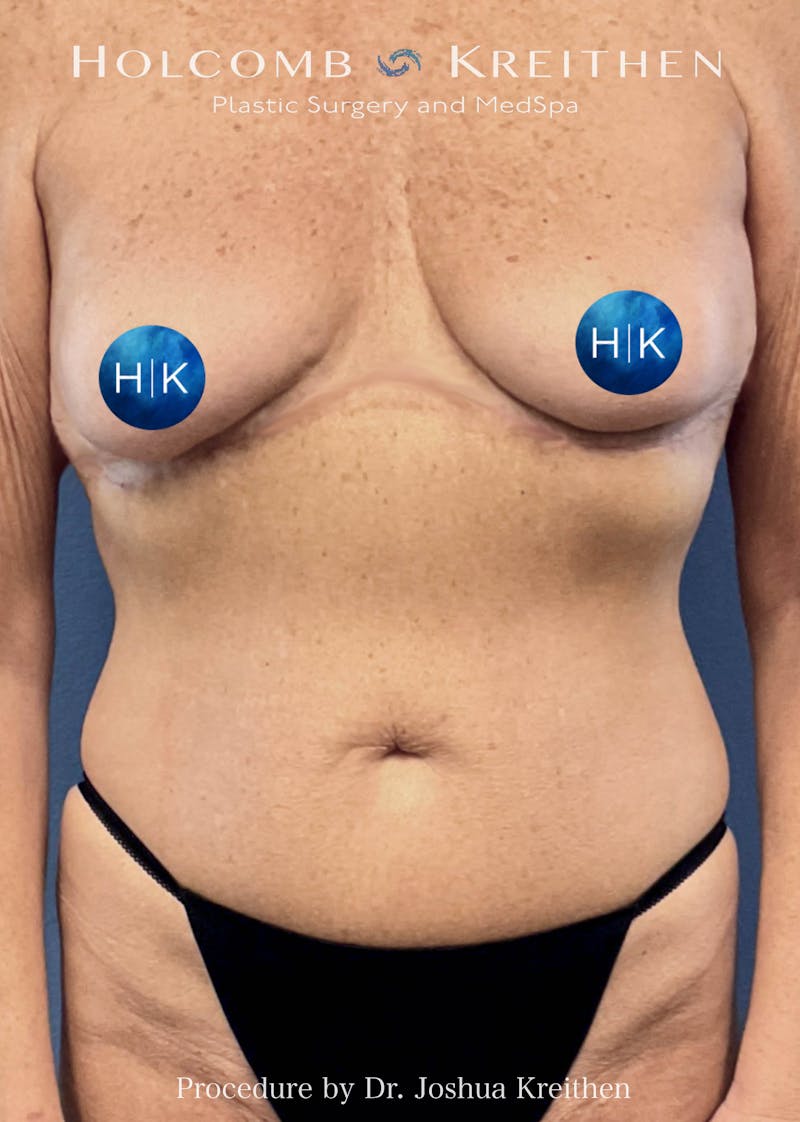 Tummy Tuck Before & After Gallery - Patient 282582 - Image 2